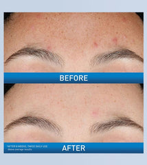 CeraVe Resurfacing Retinol Serum – Acne Marks Fading Pore Smoothing Encapsulated Niacinamide Facial Treatment 30mL