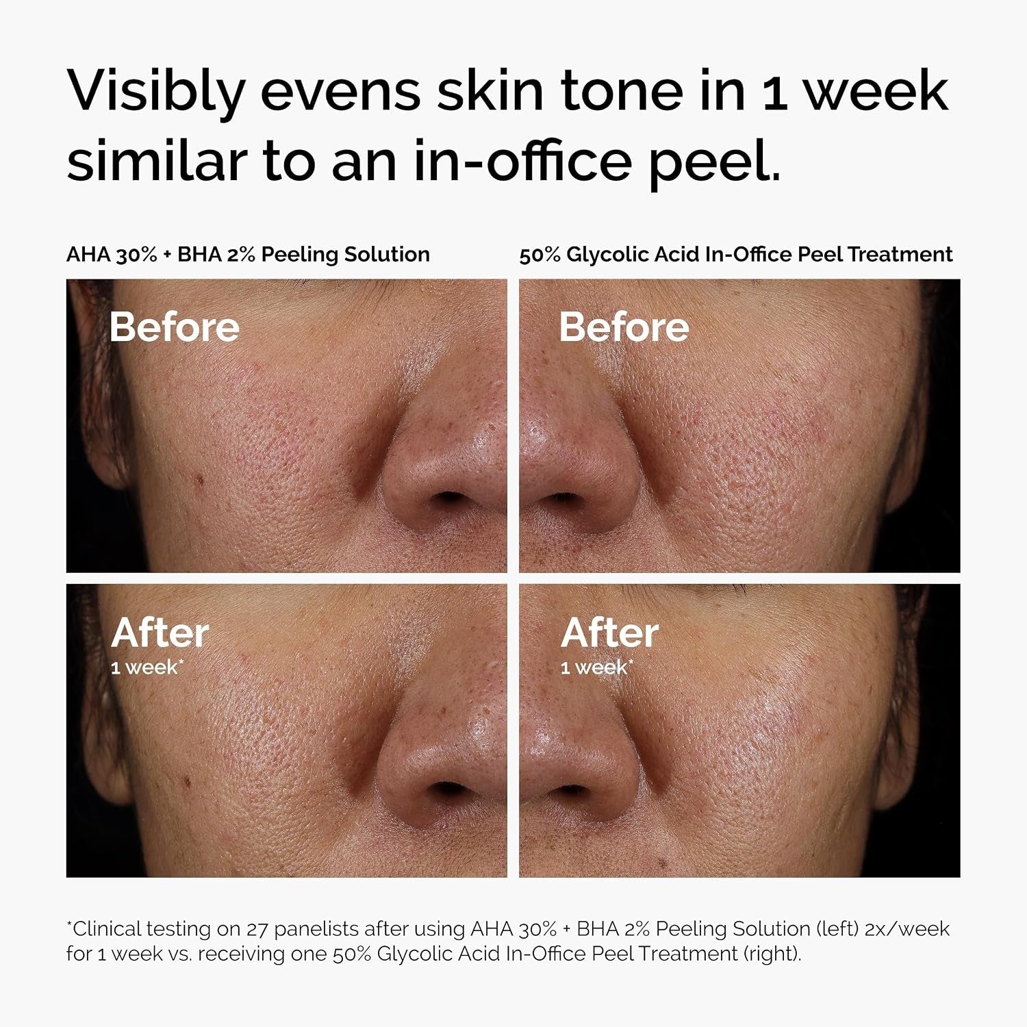 The Ordinary AHA 30% + BHA 2% Peeling Solution – Exfoliating Acne Blemish Care Smooth Texture Facial Treatment 30mL