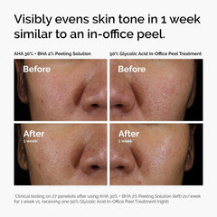The Ordinary AHA 30% + BHA 2% Peeling Solution – Exfoliating Acne Blemish Care Smooth Texture Facial Treatment 30mL